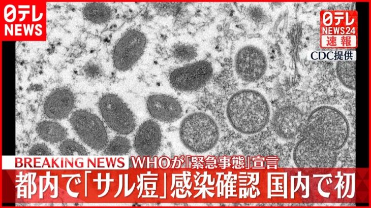 【緊急】国内初！東京都で「サル痘」の感染者を確認ｗｗｗｗｗｗ