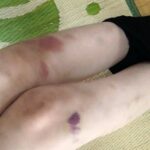 【芸能】女優・友寄蓮、16歳で白血病発覚前に触れただけでできた足の痣「ちょっとおかしい」