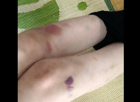 【芸能】女優・友寄蓮、16歳で白血病発覚前に触れただけでできた足の痣「ちょっとおかしい」
