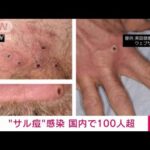 【注目】西日本でも拡大‼国内感染者100人超のサル痘に注意喚起‼